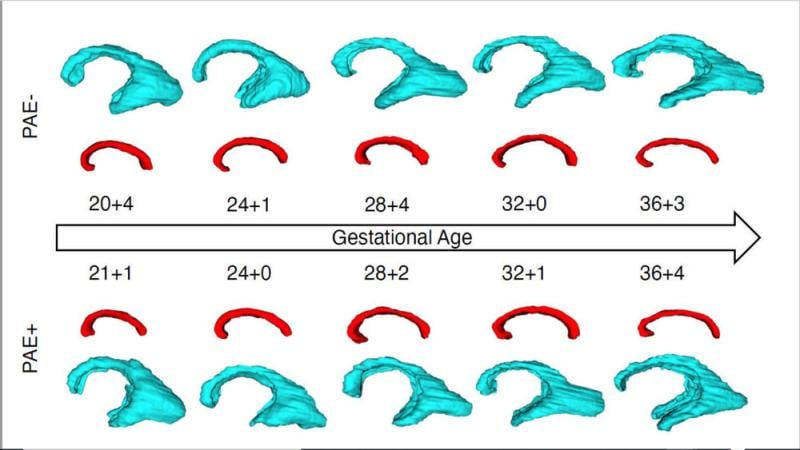 Longitudinal growth trajectories of the periventricular zone (blue) and the corpus callosum (red) in fetuses with (PAE+) and without (PAE-) prenatal alcohol exposure. Image courtesy of RSNA