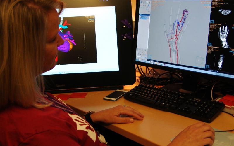 Robyn Augustyn displays an arteriovenous malformation that was fixed interventionally on the basis of a volume rendering created using Philips' IntelliSpace Portal at Phoenix Children's Hospital.