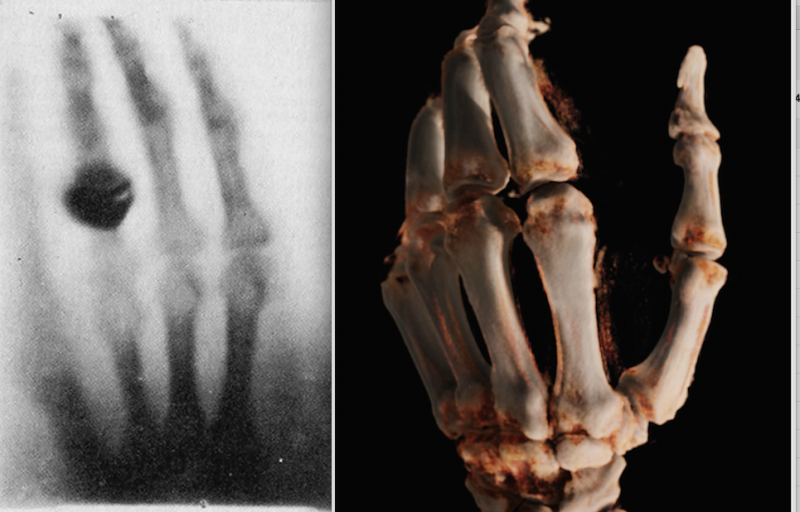 Left, the first X-ray ever made of Roentgen's wife's hand in 1895. Right, a cone-beam CT 3-D reconstruction of a hand in 2015 using a new robotic digital radiography (DR) X-ray system. 