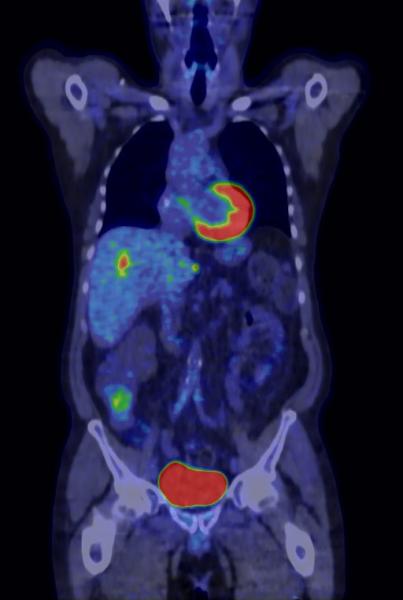PET/CT helps bring personalized medicine within reach of practitioners. (Image courtesy of GE Healthcare)