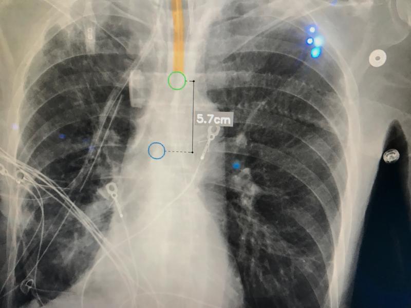 The GE Healthcare AMX mobile DR X-ray system includes an artificial intelligence feature to detect misplaced endotracheal tubes so the attending physician can immediately be notified.
