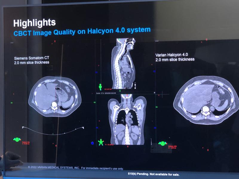 The Halcyon Hypersight offers improved spatial and contrast resolution to more precisely target tumor volumes and increase sparing of healthy tissue, and allows calculation of dose distribution directly on the CBCT image.