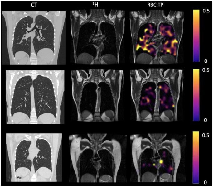 CT, proton (1H), and proton and RBC:TP imaging from post-hospitalized COVID patients. There is minimal damage on cT, and yet highly heterogeneous and low RBC:TP in the lungs of post-hospitalized COVID-19 patients. Image courtesy of Grist JT et al., published online in Radiology on May 24, 2022.