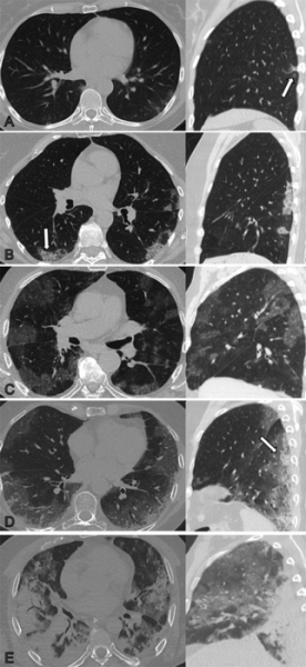 Non-contrast axial and sagittal chest CTs corresponding to the CT severity score. 