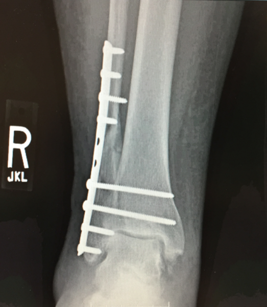 A orthopedic reconstructive surgical repair of a Pott's fracture of the fibula. Patient Marilyn Fornell.