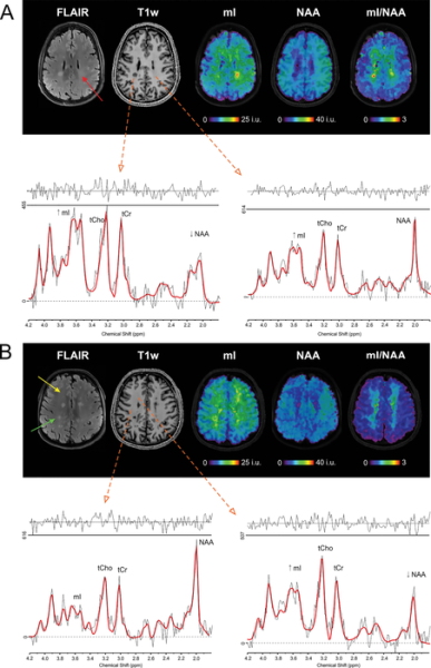 (A, B) Sample spectra and abnormal metabolic images of myo-inositol (mI), N-acetylaspartate (NAA), and the ratio of mI to NAA (mI/NAA) together with MRI scans in two participants with multiple sclerosis. Red arrow in A indicates region in normal-appearing white matter with higher signal intensity of mI only. Yellow arrow in B indicates region with higher signal intensity of mI and reduced signal intensity of NAA, where no changes or only diffuse changes are visible at T1-weighted MRI (T1w)/ fluid-attenuated