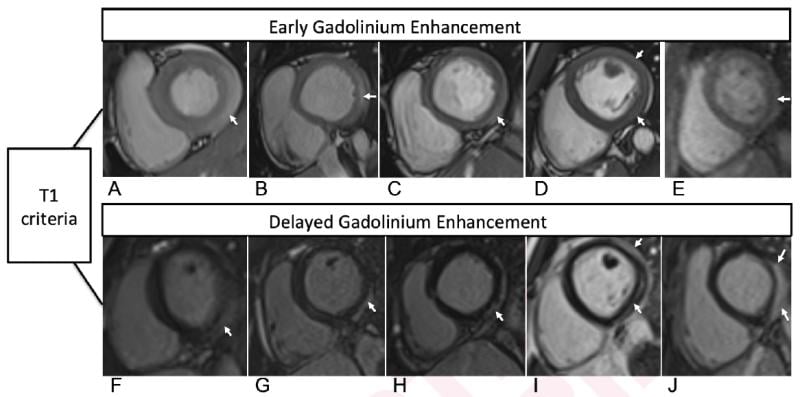Cardiac MRI T1-based criteria for myocarditis in patients with recent COVID-19 mRNA caccination. Early gadolinium enhancement (EGE) compared with precontrast SSFP sequence (not shown) is observed on early post-contrast short-axis SSFP images in (A) 16-year-old male, (B) 17-year-old male, (C) 16-year-old male, and (D) 19-year-old male, and on early postcontrast short-axis perfusion image in (E) 17-year-old male (arrow, A-E). Late gadolinium enhancement (LGE) is also present (arrows) in all 5 patients (F, G, 