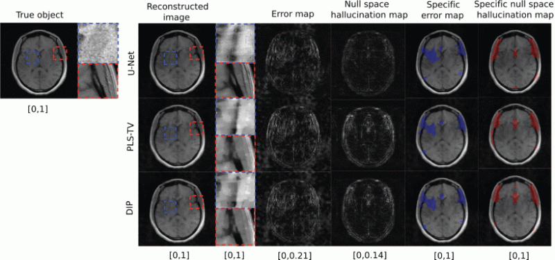 Example of a true object and reconstructed images along with error maps and hallucination maps (null space) for IND data with different reconstruction methods – U-Net (top), PLS-TV (middle) and DIP (bottom). Expanded regions are shown to the right of the reconstructed images. The specific error map (blue) and specific null space hallucinations map (red) are overlaid on the reconstructed images for each method. The image estimated by the U-Net method has visibly lower hallucinations in the null space compare