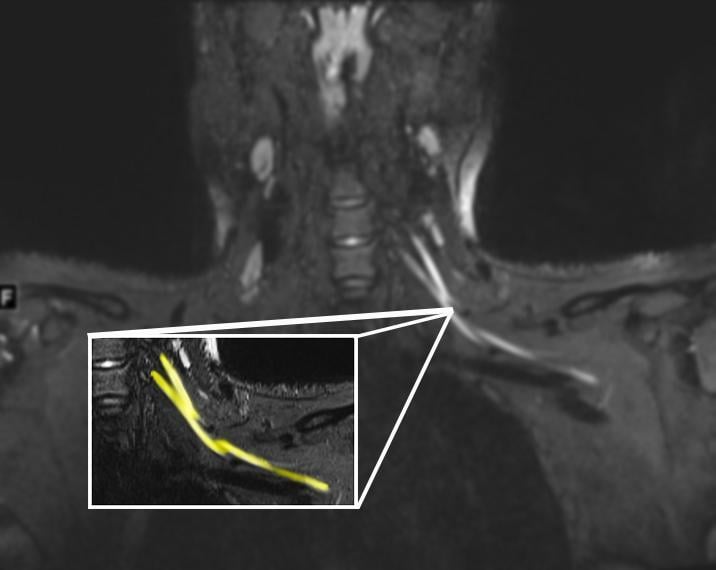 An MR image of a patient in their early 20s shows nerve injury (highlighted in yellow) of the left brachial plexus in the neck. The patient experienced left arm weakness and pain after recovering from COVID-19 respiratory illness, which prompted them to see their primary care physician. As a result of the MRI findings, the patient was referred to the COVID-19 neurology clinic for treatment. Image courtesy of Northwestern University #COVID19 #COVID #SARSCoV2