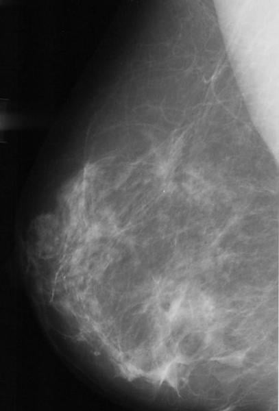 Figure 9. Normal mammogram.