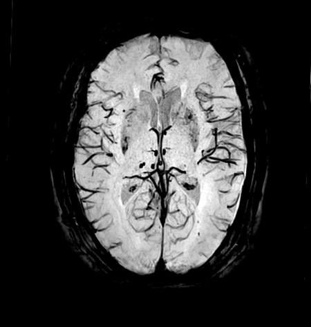 Brain image taken on an Echelon Oval 1.5T MR scanner