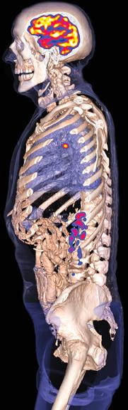 Nuclear Medicine is the New Personalized Medicine