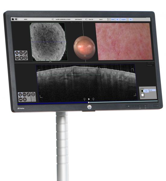  Photonics VivoSightDX OCT cancer detection screen