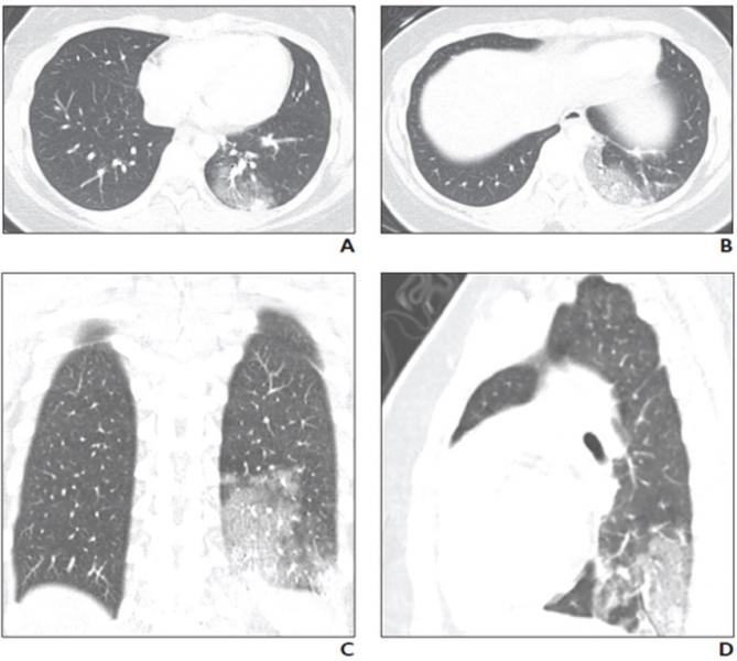 16-year-old girl with coronavirus disease (COVID-19) who presented with shortness of breath. Reverse transcription–polymerase chain reaction testing confirmed diagnosis of severe acute respiratory syndrome coronavirus 2 (SARS-CoV-2).