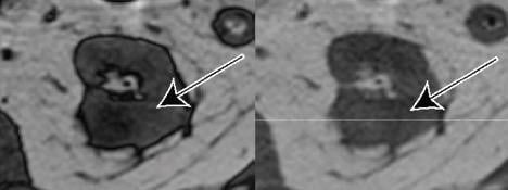Axial T1-weighted gradient echo opposed-phase and in-phase images.