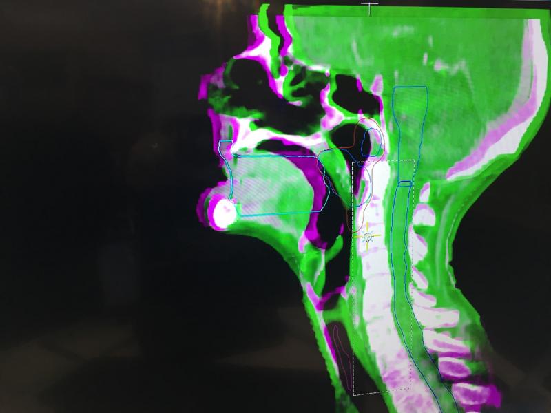 A radiation therapy treatment plan showing contours of critical structures that beams need to avoid to limit damage to healthy tissue. This was show on a workstation in the Elekta booth at HIMSS 2019.
