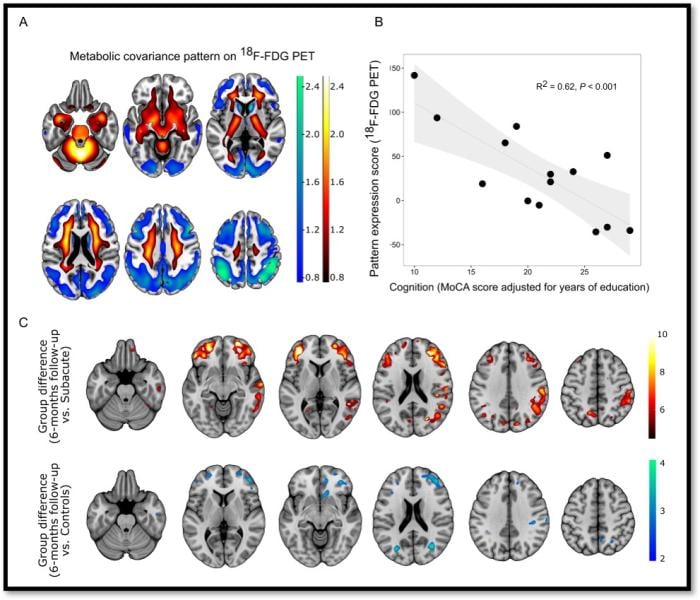 SNMMI's Image of the Year is a detailed depiction of areas of cognitive impairment, neurological symptoms and comparison of impairment over a six-month time frame