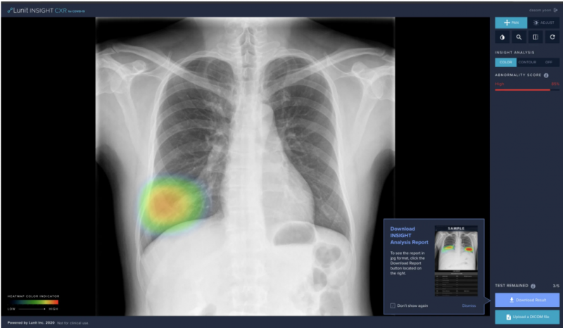 A screenshot of Lunit INSIGHT CXR for COVID-19 analyzing a lung consolidation case. In light of the outbreak, the service is currently provided online for free. #COVID19 #Coronavirus #2019nCoV #Wuhanvirus #SARScov2