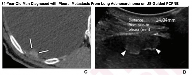 Enhanced axial CT (C) shows nodular pleural thickening (arrows). US image for the corresponding lesion on CT (D) shows nodular pleural morphology (arrowheads). Distance from skin to pleura, measured as the perpendicular distance between the skin and the pleural puncture site, was 14.04 mm.
