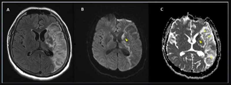 Stroke seen in a 41-year-old male patient with COVID-19 infection. More images from the study can be found at the bottom of this article. 