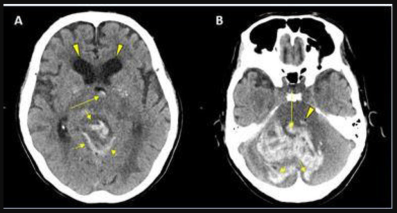 CT showing hemorrhage in a 68-year-old male patient with COVID-19 infection.