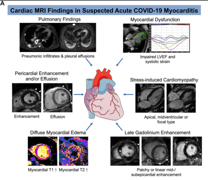 Example of cardiac MRI findings in suspected acute COVID-19 myocarditis. Note: this image is for illustrative purposes only and is not associated with the Big Ten study group. Image courtesy of Radiology: Cardiothoracic Imaging.
