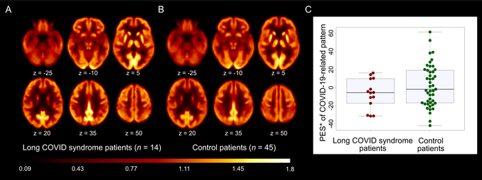 18F-FDG PET in patients with long-COVID syndrome. A and B: Transaxial sections of group averaged, spatially normalized 18F-FDG PET scans in patients with long-COVID syndrome (A) and control patients (B). C: The pattern expression score (PES; *adjusted for age and sex, for illustration purposes) of the previously established COVID-19-related spatial covariance pattern was not significantly different between patients with long-COVID syndrome and control patients. Boxplots (grey), as well as individual values 