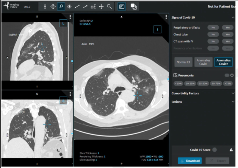 In the STOIC study, readers classified CT exams as COVID positive, COVID negative or normal. The readers had access to the CT scans using a 3-D image visualization web application, allowing scrolling through the entire lung volume in the coronal, sagittal or axial transverse plane. The CT scan shown here has been classified as COVID positive due to the presence of bilateral ground glass opacities and absence of features such as mucoid impaction, bronchiolar nodules, segmental or lobar consolidation. Image c