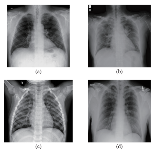 Samples from the dataset used in this study. (a) X-ray with PA view of a patient with COVID-19; (b) X-ray with AP view of a patient with COVID-19; (c) X-ray of a healthy patient from Dataset A; (d) X-ray of a healthy patient from Dataset B. Images courtesy of IEEE/CAA JOURNAL OF AUTOMATICA SINICA