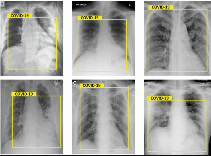 What does COVID look like on X-ray, CT, medical imaging? Radiologic presentations of COVID-19.  An example of a COVID-19 pneumonia of a chest CT scan. The COVID appears as white ground glass opacities (GGOs) in the lungs. Normal lungs on CT should appear black. #COVID #COVID19 #Coronavirus
