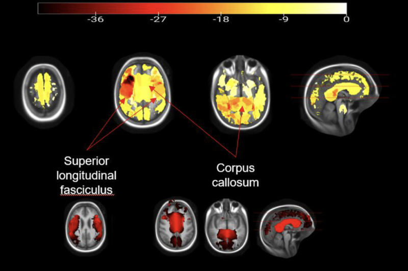 Figure 3. The integrity of the white matter is extensively impaired with higher BMI in children. Most affected are the corpus callosum, which is the main connector of both brain hemispheres, and the superior longitudinal fasciculus that connects several (frontal, occipital, parietal and temporal) lobes.