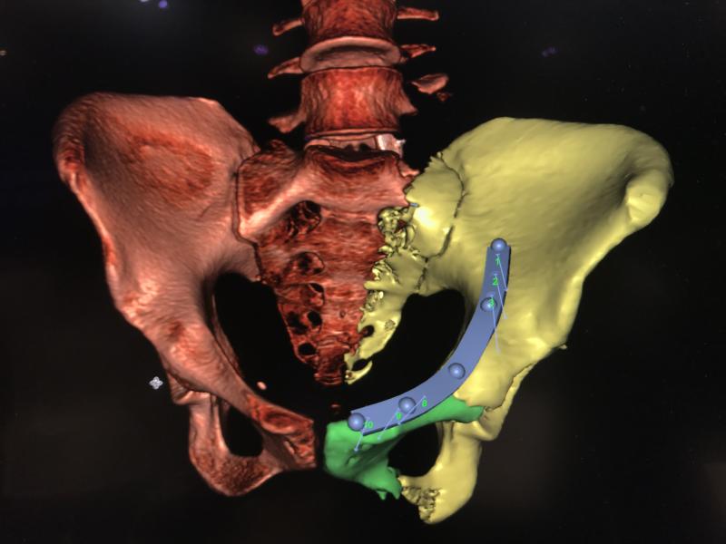 Fractured hip CT image reconstruction with orthopedic repair planning shown on the Sectra enterprise imaging system. #RSNA21 #RSNA2021 #RSNA