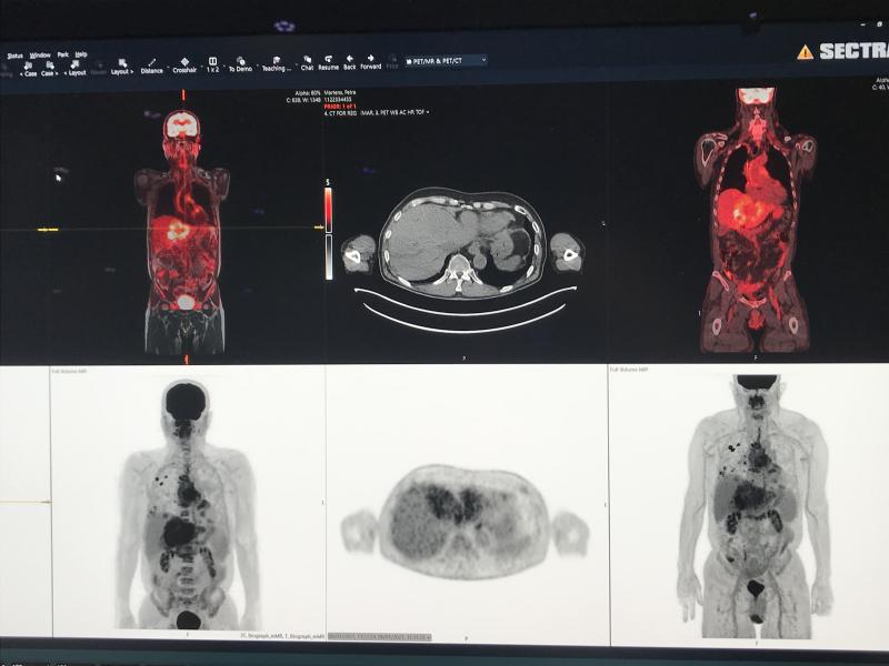 Example of nuclear imaging PET-CT showing a liver cancer patient with multiple metastases. Shown as part of a demo on the Sectra enterprise imaging system. 