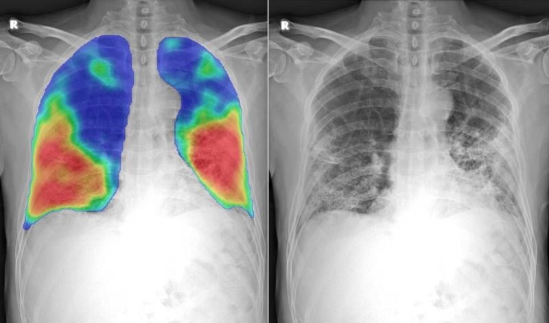 Numerous vendors have developed artificial intelligence (AI) algorithms to automatically detect and score the severity of COVID-19 pneumonia in the lungs from CT or DR imaging. This chest X-ray shows the CAD4COVID AI software developed by Thirona and Delft Imaging. It will generate a score between 0 and 100 indicating the extent of COVID-19 related abnormalities, display such lung abnormalities through a heatmap and quantify the percentage of the lung that is affected. The COVID areas of the lung appear as 