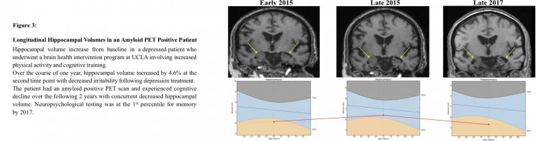 Hippocampal volume increase in depressed patient on MRI