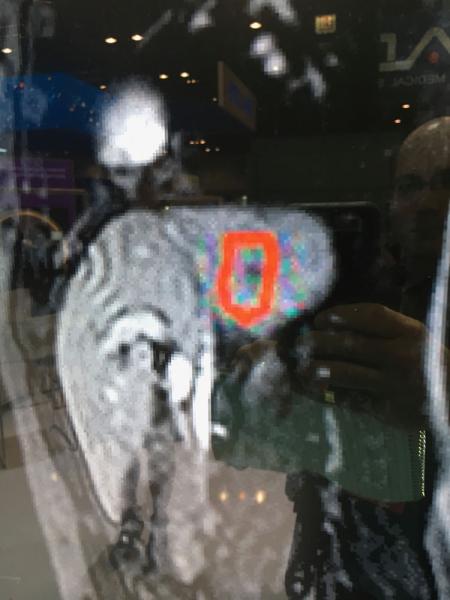 This is an example of the real-time MRI imaging of radiation therapy beam delivery on a liver tumor demonstrated with the Elekta Unity MRI-guided RT system at ASTRO 2019. It shows how real-time imaging can show organ/tumor motion due to respiration. Currently the radiation therapist can turn the beam off if the tumor moves out of tolerance, but the company is working toward automated beam off/on features to account for motion.#ASTRO19 #ASTRO2019 #ASTRO