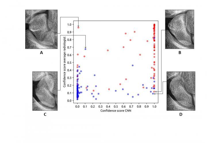 Scatter plot of the confidence score of the detection convolutional neural network (CNN) versus the average confidence score of the radiologists per fracture case (n = 95) and nonfracture case (n = 95) in Dataset 3. Fracture and nonfracture cases are respectively marked with a red and blue color (ground-truth). The confidence scores range from 0 to 1, where 1 means absolute certainty that a fracture is present. Example radiographs where the CNN and radiologists showed a high disagreement are shown next to t