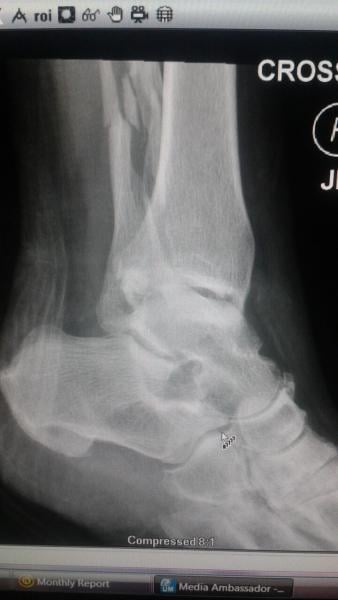 A Pott's fracture of the fibula, also called a spiral fracture. Patient Marilyn Fornell.