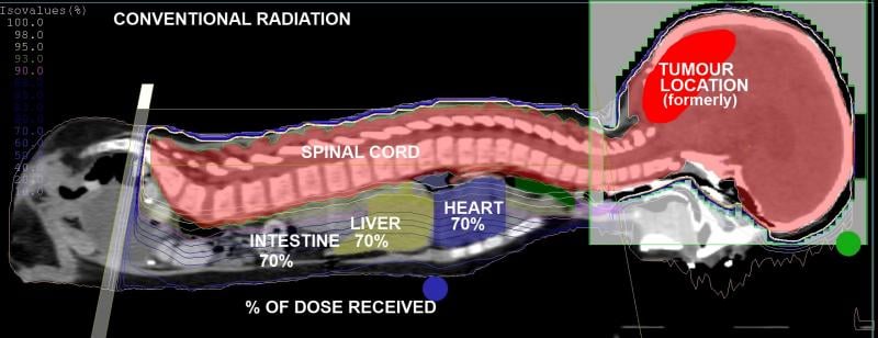 Pediatric Brain Tumor Patient From the U.K. Undergoes First Treatment of Proton Therapy