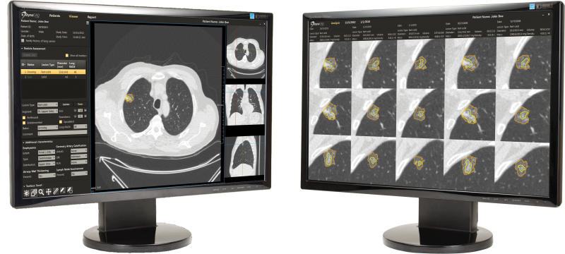  Philips_Lung cancer DualScreens