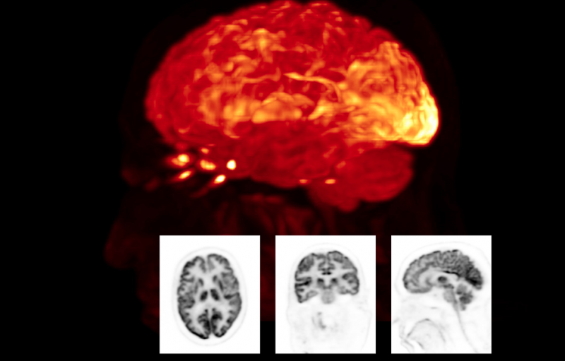 Nuclear brain scan performed on a Biograph Vision positron emission tomography/computed tomography (PET-CT) system from Siemens Healthineers.