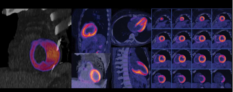 Nuclear myocardial perfusion scan performed on a Biograph Vision positron emission tomography/computed tomography (PET-CT) system from Siemens Healthineers.