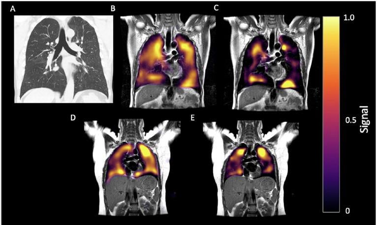 60-year-old man with long-COVID. History of post-COVID breathlessness, shown 172 days after discharge. (A) CT, (B) Xenon-129 MRI imaging of ventilation and (C) RBC phase imaging. (D) Xe-129 MRI gas and (E) RBC phase imaging for a healthy control. Xe-129 MRI images shown in the coronal view for both, with disrupted RBC in the patient due to micro-emboli. Image courtesy of RSNA.