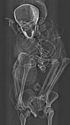 X-ray of pharaoh Seqenenre-Taa-II's torso