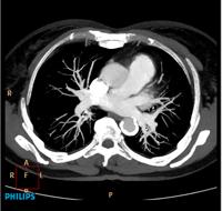 Pulmonary CTA using an Ingenuity CT scanner.