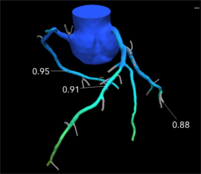An example of a HeartFlow FFR-CT image showing the blood flow through what looked like a significant blockage on CT angiography alone, actually was not flow-limiting based on computational fluid dynamics. Use of the technology was supposed to reduce the number of diagnostic catheterizations in the FORECAST trial, but the costs of FFR-CT were not offset enough to show cost savings.