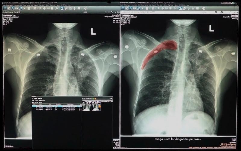 Highlighted region (red) includes signs of pneumothorax on a chest radiograph enhanced by a smart algorithm embedded in GE Healthcare’s Edison Open AI Orchestrator. (CE mark version of software; not commercially available in United States). Screenshot by Kirk Graczyk