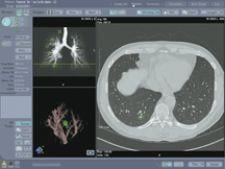 Lung CT Scan 