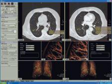 CT scanning for lung cancer CAD software for multislice CT.