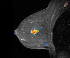 CAD Takes On Breast MR, Reduces Biopsy Rates